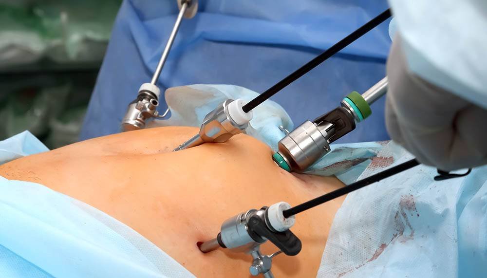Laparoscopy