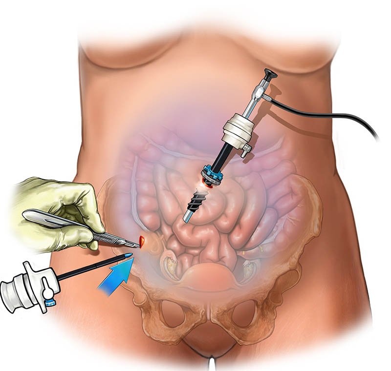 Laparoscopy
